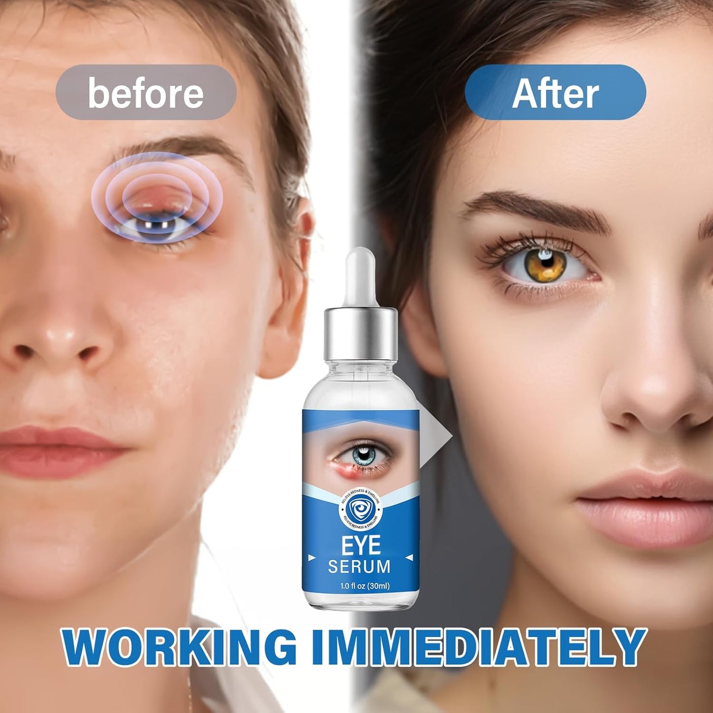 Eye Treatment, Effective Eye Serum for Chalazion and Blepharitis Treatment, 30mL Gentle Lash and Eye Cleanser, Blue