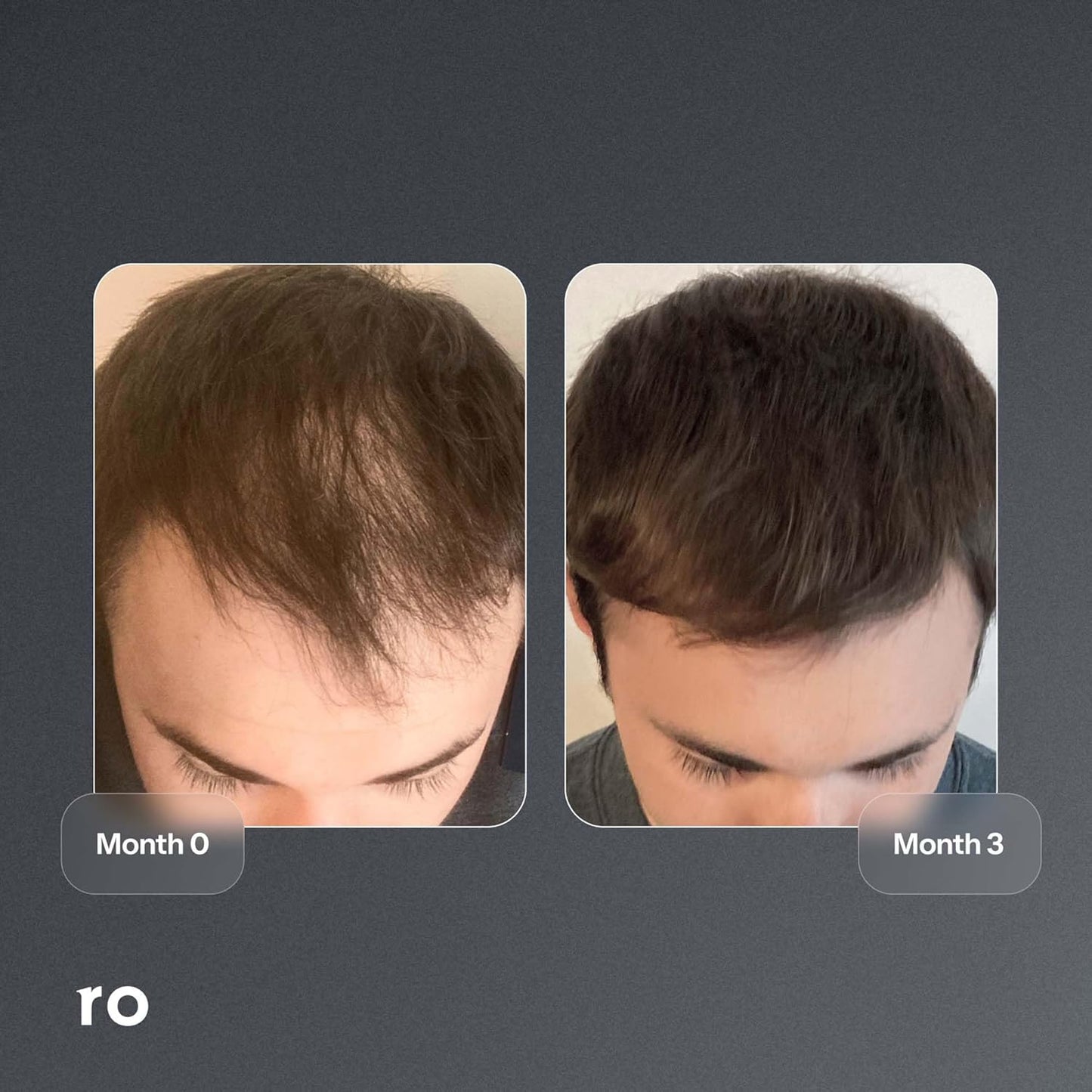 ROMAN Minoxidil 5% Solution for Men's Hair Loss and Regrowth, Unscented Liquid, Clinically Proven, 2 fl oz