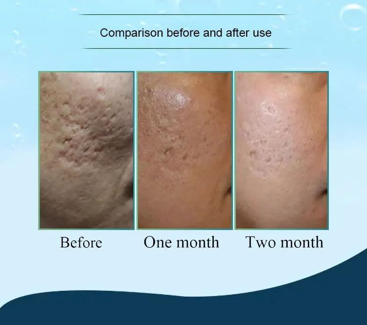 Hydra Needle 20 Titanium Serum Applicator Tools Reusable