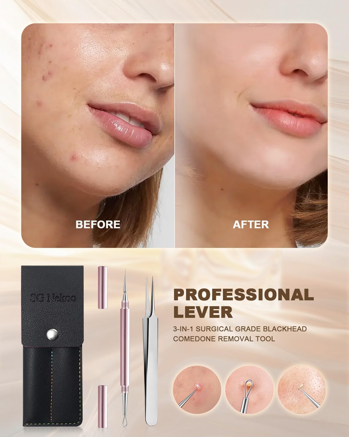 SGNEKOO Professional Facial Milia Removal Tool and Whitehead Extractor,Titanium Alloy Double Ended Needle and Steel Tweezers Kit,Blackhead,Blemish,Zit and Pimple Acne Remover Popper (Stainless Pink)