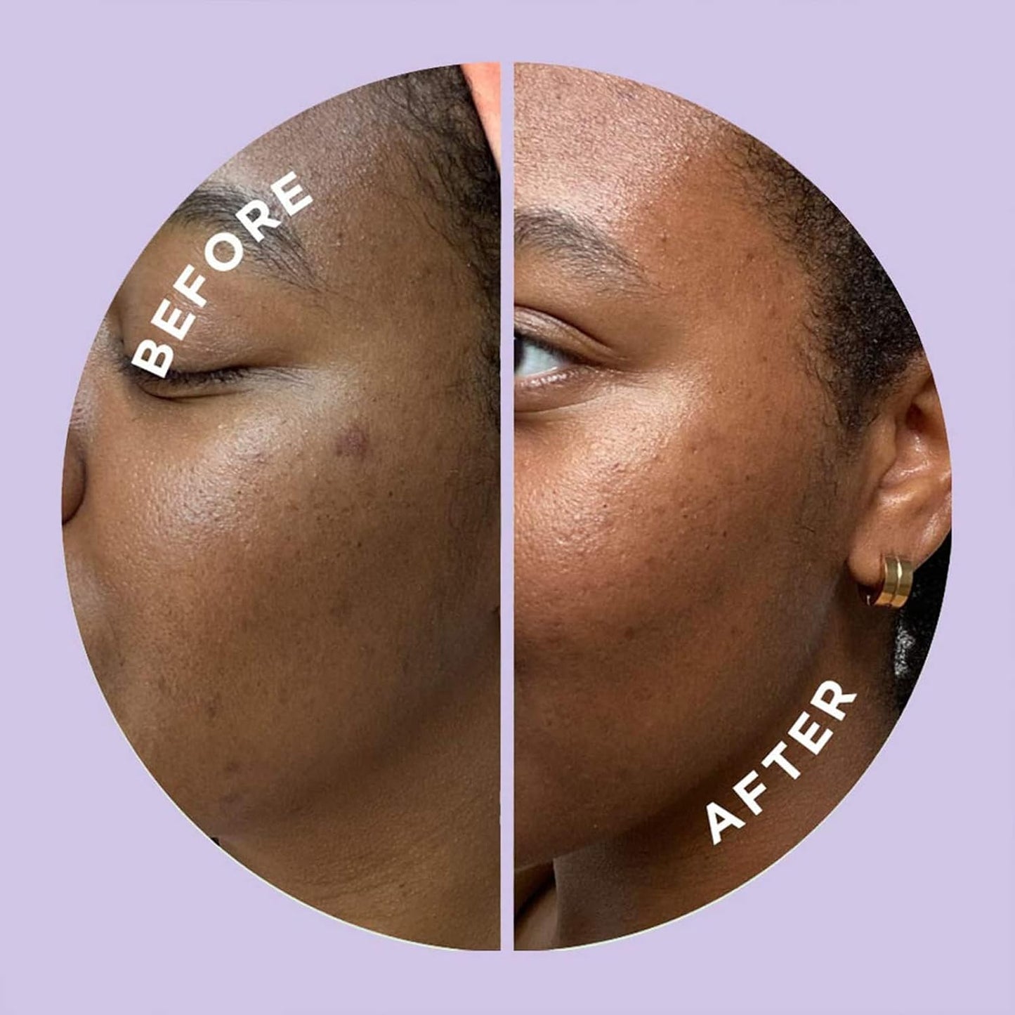 ZitSticka Hyperfade Microdart Pimple Patch, Targets Post-Zit Blemishes, Hydrates & Evens Skin Tone, With Hyaluronic Acid & Vitamin C for Clear, Smooth-Looking Skin (4 count)