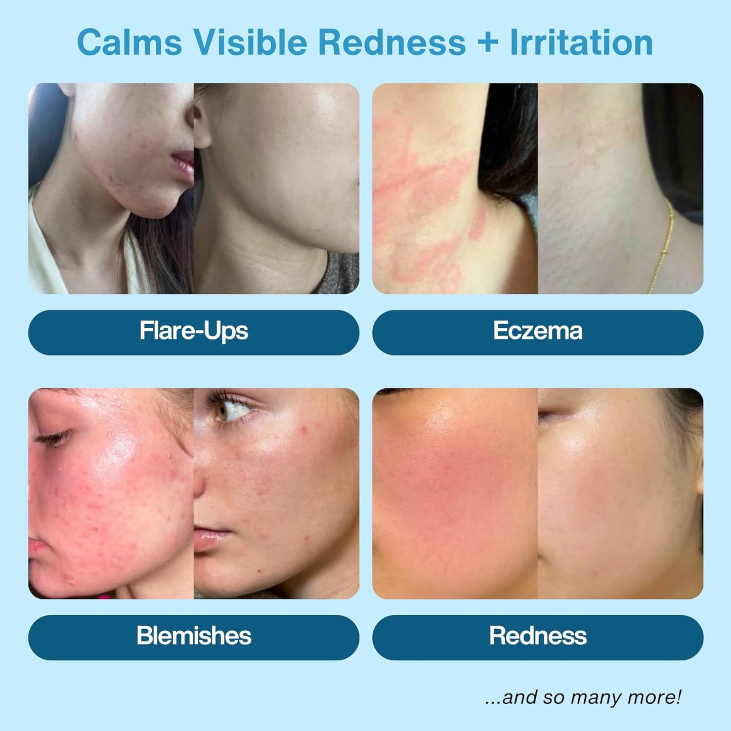 Hypochlorous Acid Spray – HOCl Face & Body Mist for Acne, Eczema & Irritation – Multi-Purpose Skin Repair – Eyelid Cleanser, Post-Workout/Procedure, Scalp & Sensitive Skin (2 oz+6.8 oz)