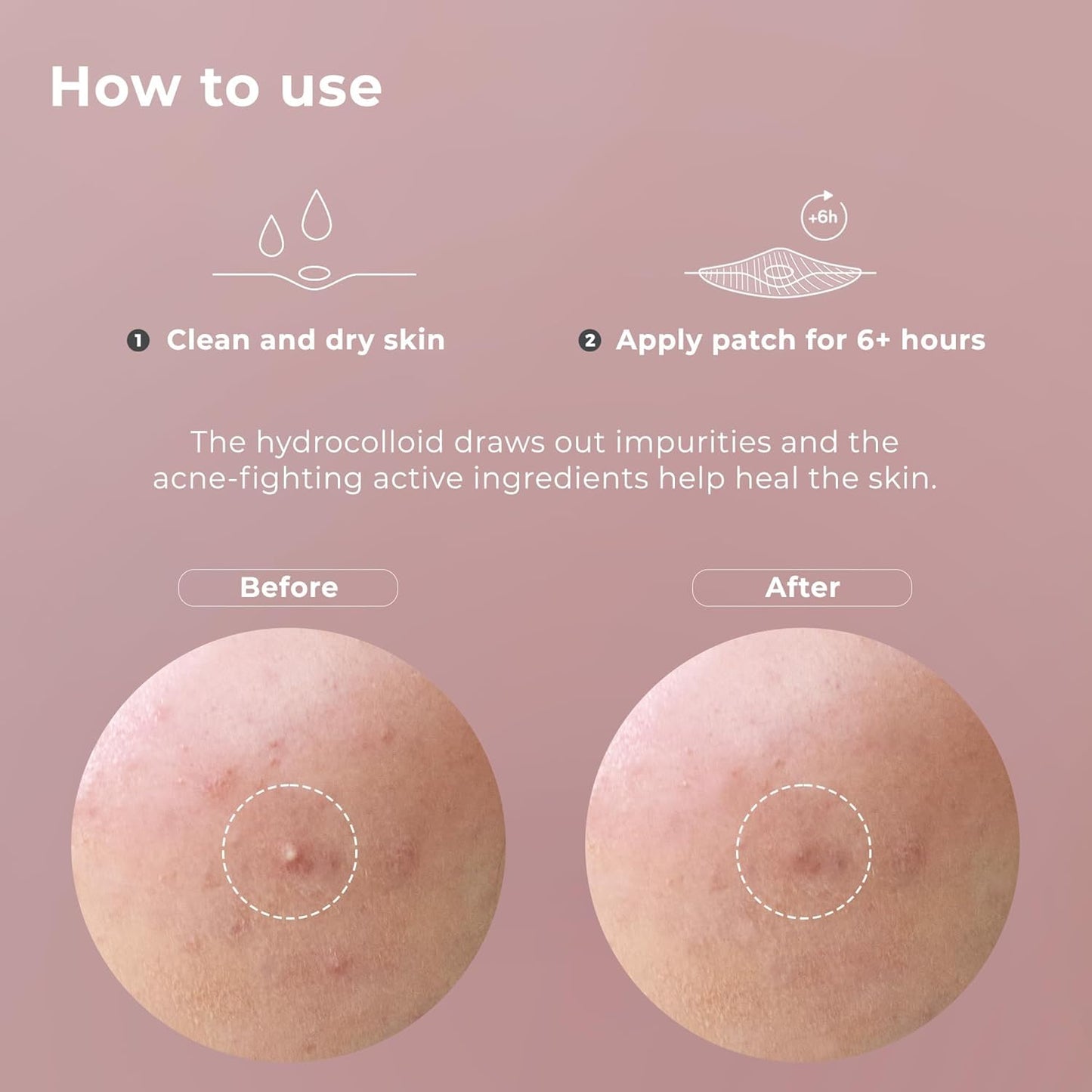 OMMA Korean Pimple Patches for Face with Hydrocolloid Patch, Invisible Blemish Pimple Stickers Acne Dots - Salicylic Acid Whiteheads Fast Acne Spot Treatment - 10 mm Zit Patches (72 Count)