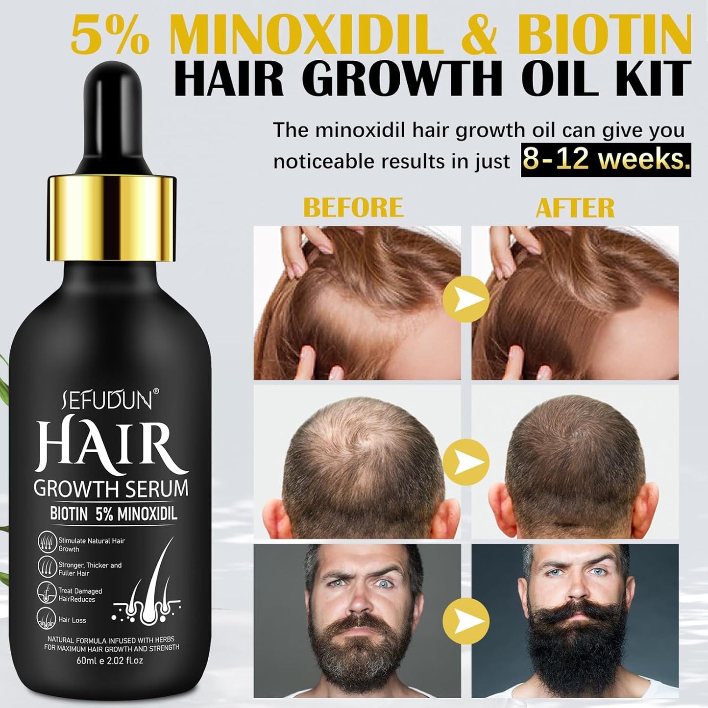 5% Minoxidil for Men and Women with Derma Roller, Hair Growth Serum & Beard Growth Kit, Minoxidil Biotin Hair Regrowth Treatment for Thicker, Fuller Hair - Stop Scalp Hair Loss & Thinning - 2.02 oz