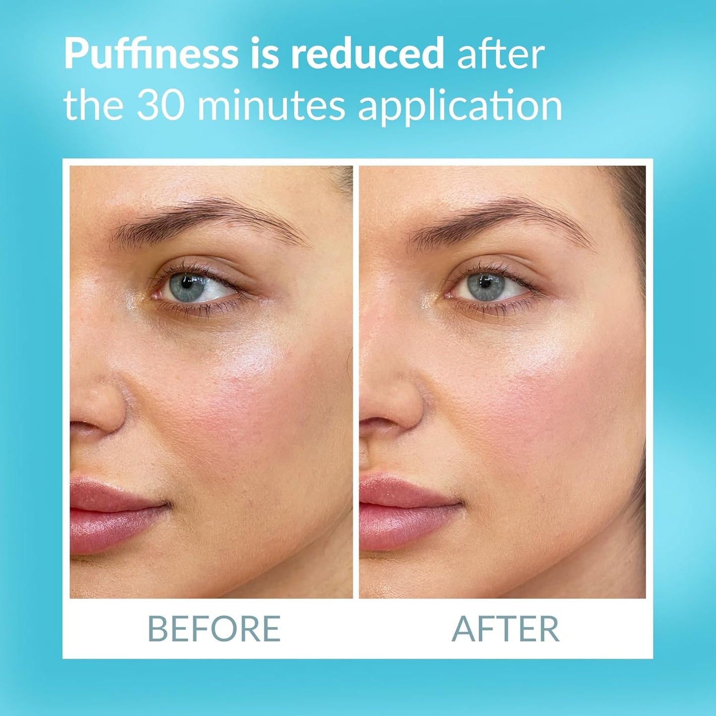 Talika Eye Therapy Patch - Instant Smoothing Under Eye Patches - Mask For Dark Circles Puffiness & Tired Eyes - 6 Refills Reusable Under Eye Patches for Adults Skincare Eye Treatment