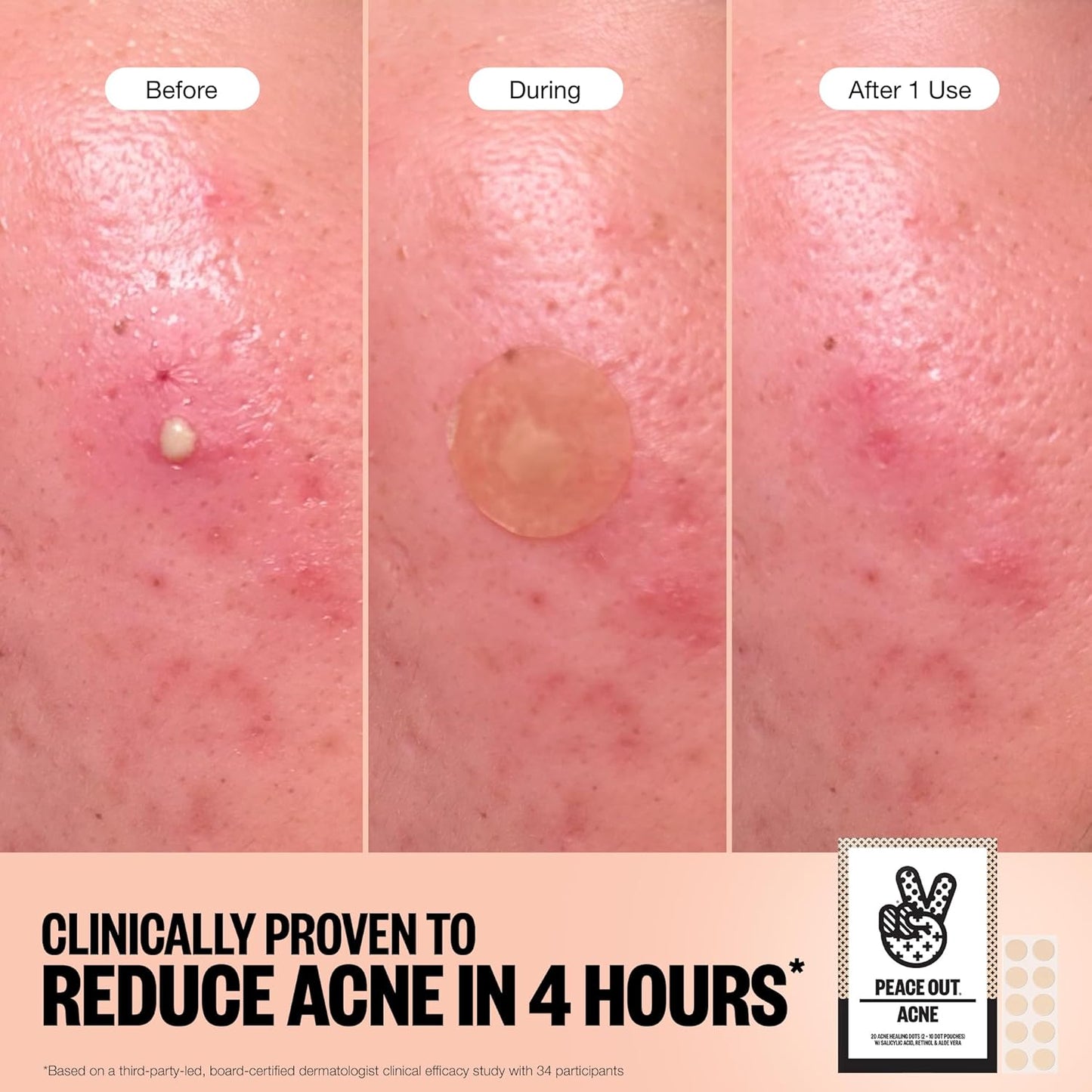 PEACE OUT Acne Healing Dots Helps Clear Blemishes Overnight, Fast Acting Hydrocolloid Pimple Patches for Breakouts with Salicylic Acid, Retinol and Aloe Vera, Award Winning Skincare Solution 20 Count