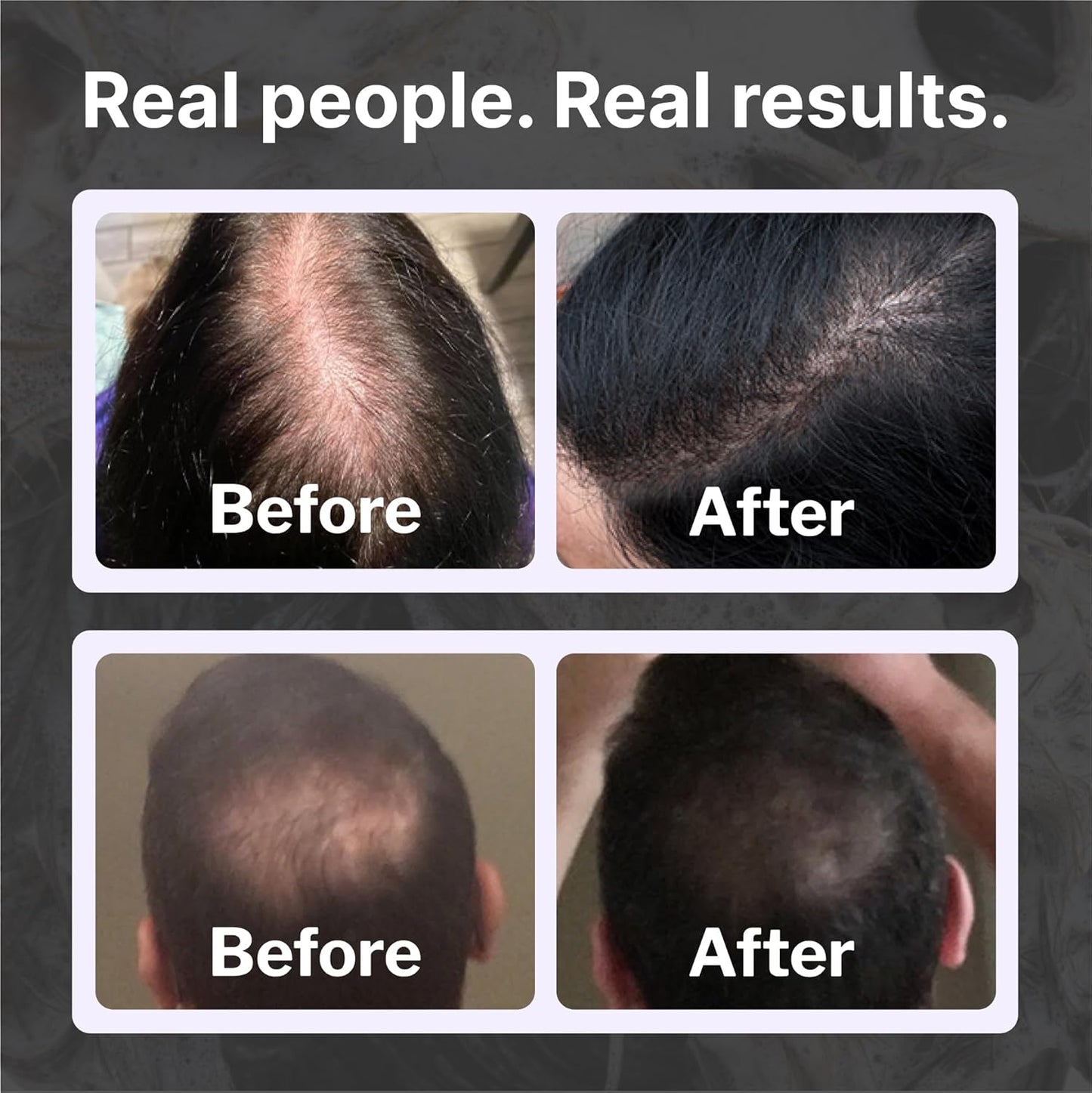 Shapiro MD Hair Growth Experts Natural Hair Kit for Thicker, Fuller, Healthier Looking Hair - Including Shampoo, Conditioner and Leave-In Daily Foam (2 Month)