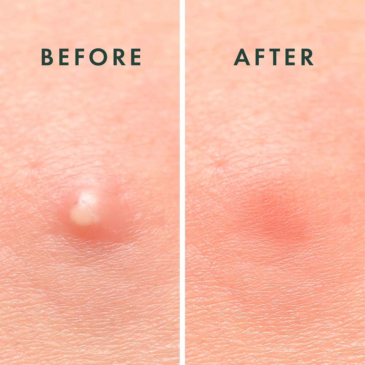 Rael Pimple Patches, Miracle Invisible Spot Cover - Hydrocolloid Acne Patch, Treatment for Breakouts, Absorbs Zits & Blemish, Korean Skin Care, 2 Sizes (48 Count)