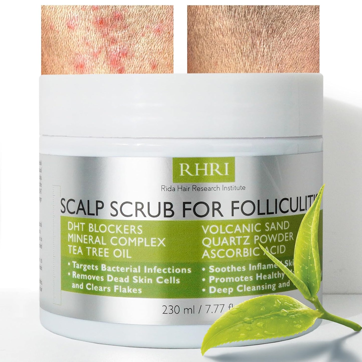 Anti Fungal Folliculitis Scalp Scrub Pre Shampoo for Seborrheic Dermatitis, Dandruff, Psoriasis, and Itchy Dry Scalp Relief